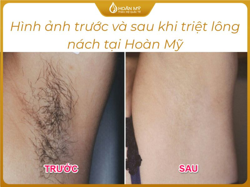 Triệt lông là gì? Cơ chế hoạt động và những điều cần biết trước khi thực hiện