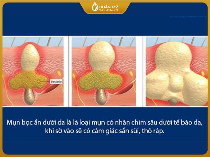 cấu trúc mụn bọc dưới da có tự xẹp không