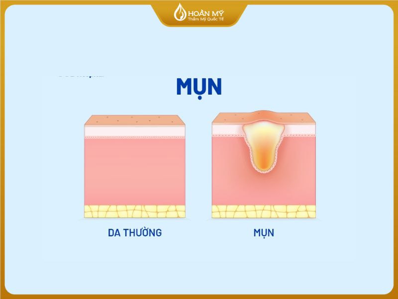 da mặt bị mụn ẩn có nên nặn không, hình ảnh da sần sùi do mụn ẩn