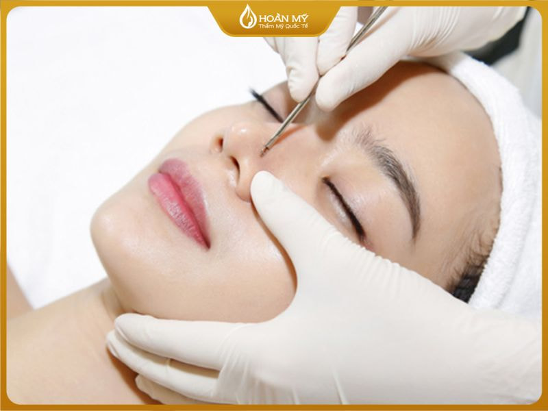 điều trị mụn ẩn không nặn có tự hết không bằng công nghệ cao cùng với kỹ thuật nặn mụn