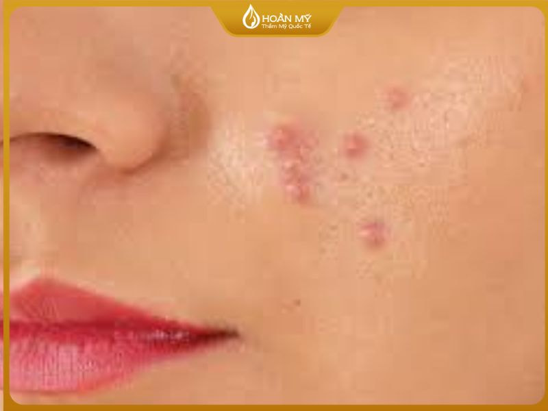 hình ảnh làn da bị mụn bọc sưng đỏ, dễ để lại sẹo nếu xử lý sai cách