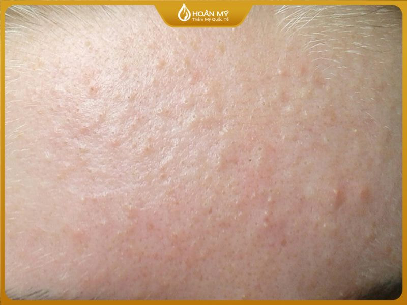 hình ảnh mụn ẩn dưới da vùng trán với nốt sần li ti không viêm