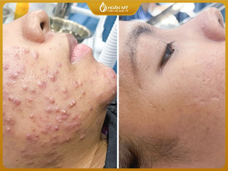 kết quả điều trị bị mụn bọc đúng cách giúp cải thiện da rõ rệt sau vài tuần