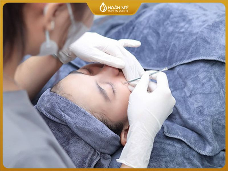 kỹ thuật viên lấy nhân mụn ẩn ở má bằng dụng cụ y khoa vô trùng