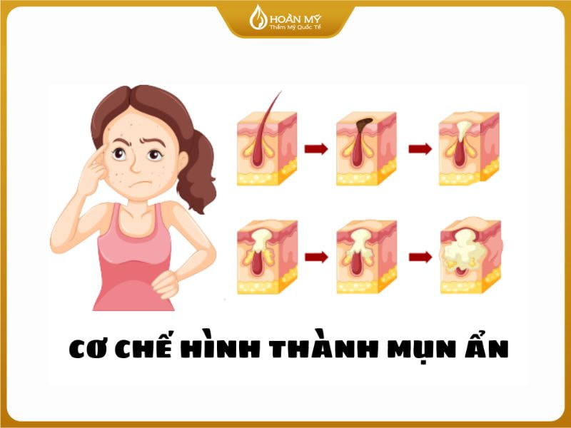 mụn ẩn không nặn có tự hết không do bít tắc nang lông nếu không xử lý kỹ sẽ gây ra viêm
