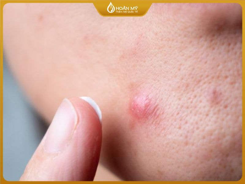 mụn viêm không cồi là gì và có nguy hiểm không