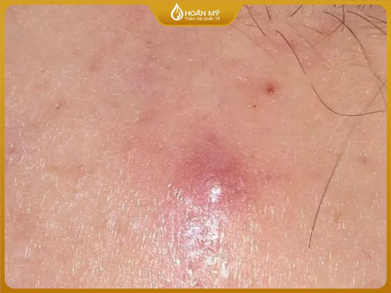 mụn viêm không nhân bôi gì để giảm sưng nhanh ở vùng má