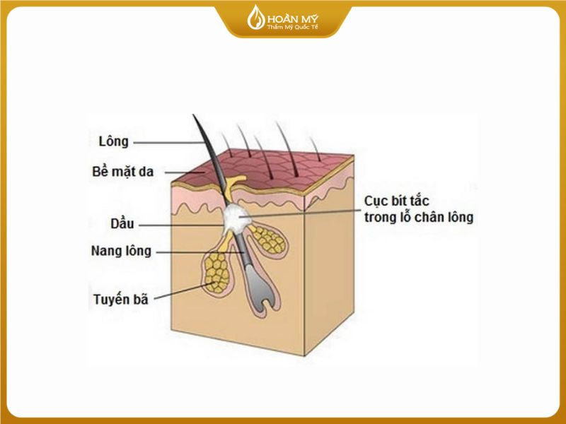nang lông bị bít tắc do dầu thừa và tế bào chết gây mụn ẩn ở má