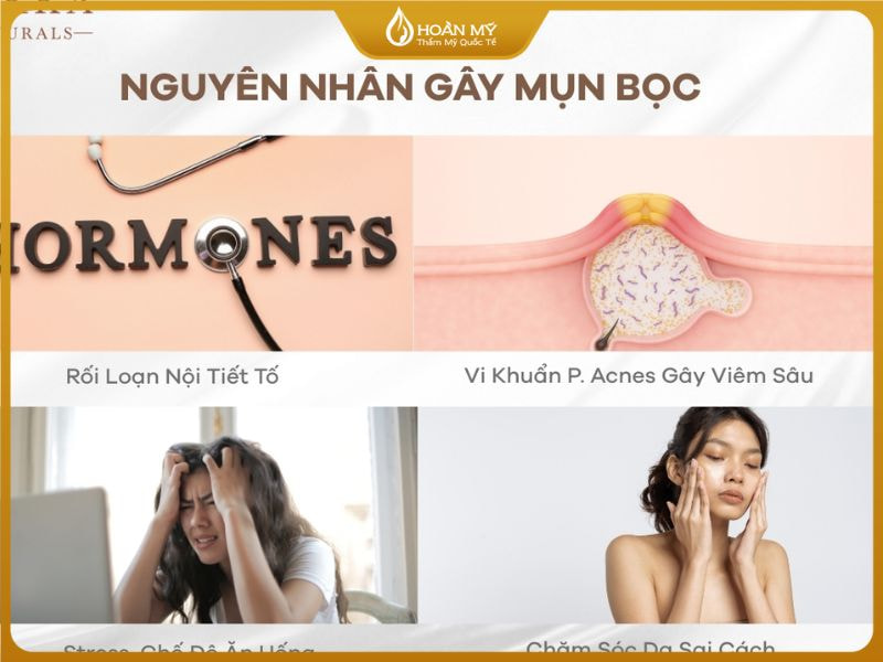 nguyên nhân bị mụn bọc có thể do nội tiết, stress, thói quen sống kém lành mạnh